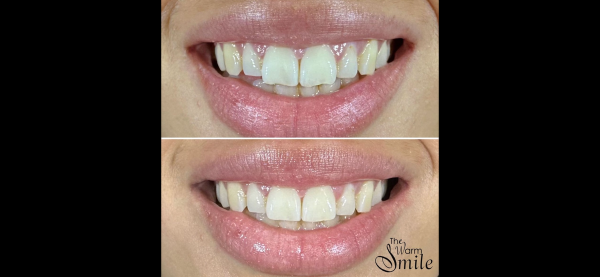 What is Teeth Reshaping? - The Warm Smile, Melbourne