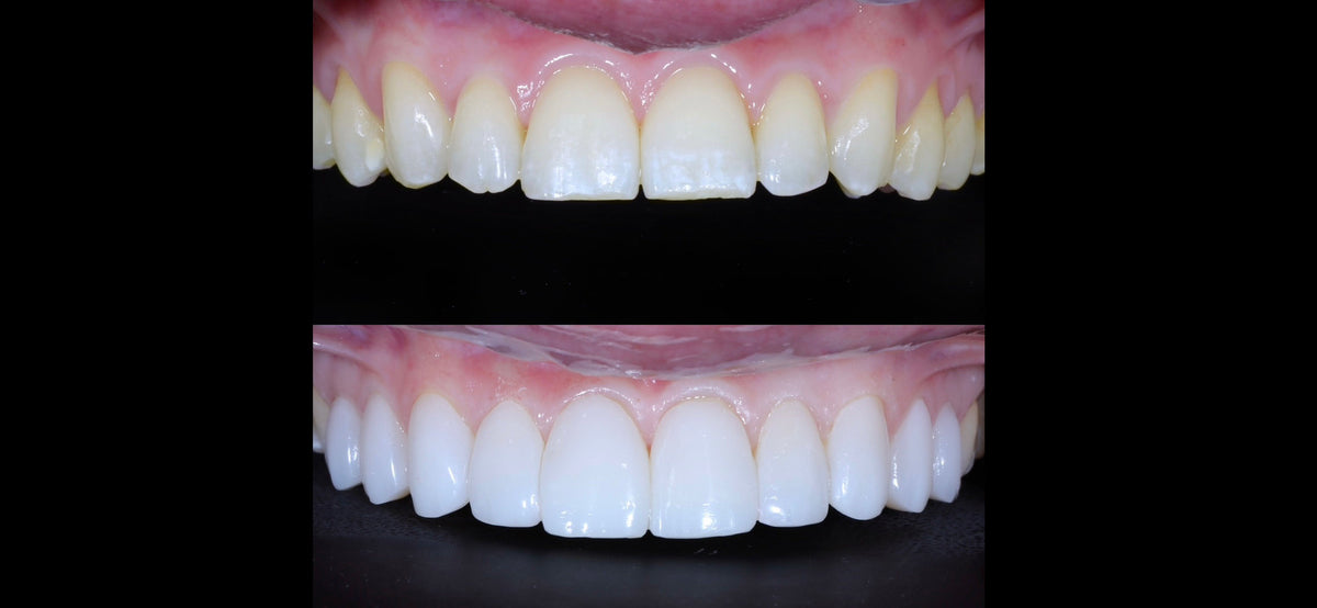 The Art of Composite Bonding - The Warm Smile, Melbourne