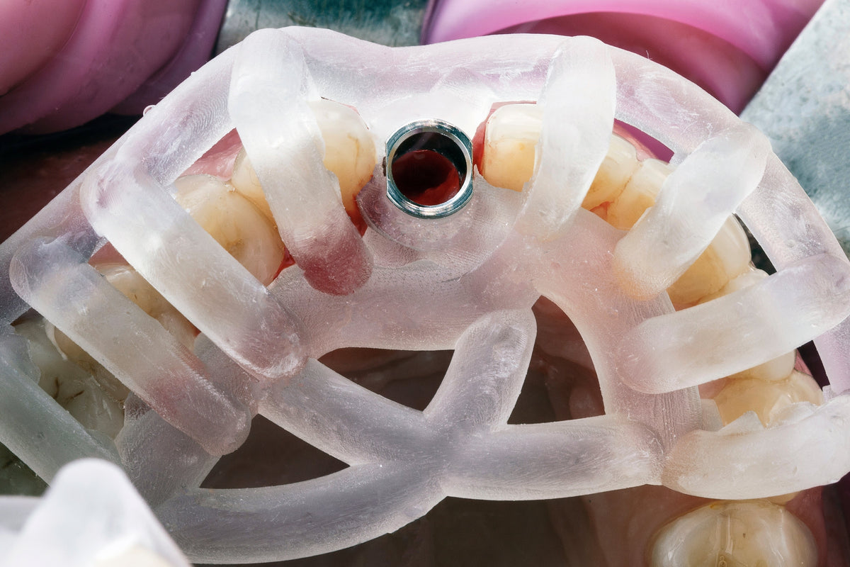 How We Plan Dental Implants Using Guided 3D Technology