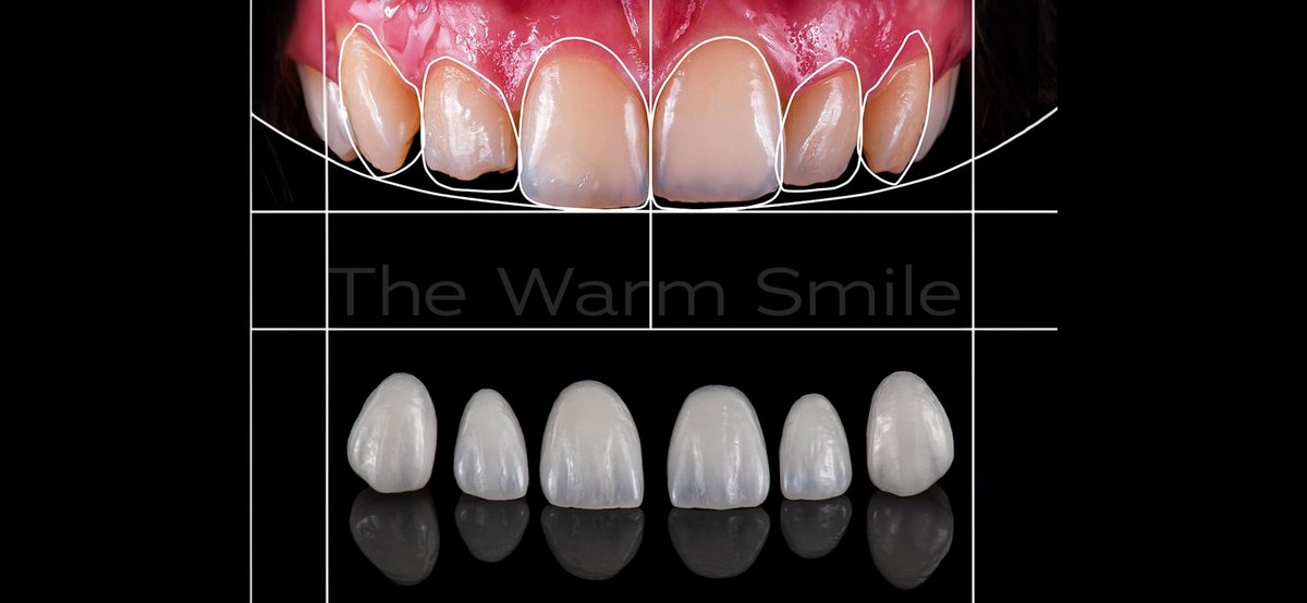 Composite Bonding vs. Other Techniques: Choosing the Right Cosmetic Solution - The Warm Smile, Melbourne